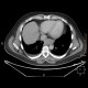 Ectopic pancreas, gigantic, pancreatic ectopia: CT - Computed tomography